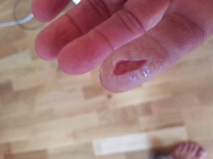 Skärskada på finger åtgärdad med MLS Laser.